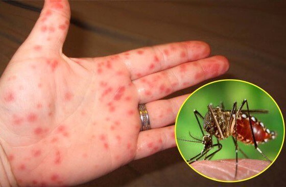 cách phòng chống muỗi sốt xuất huyết