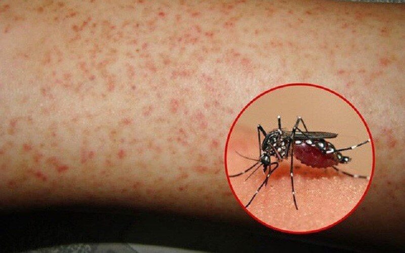 Muỗi đốt bao lâu thì bị sốt xuất huyết
