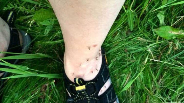 muỗi đốt lòng bàn chân