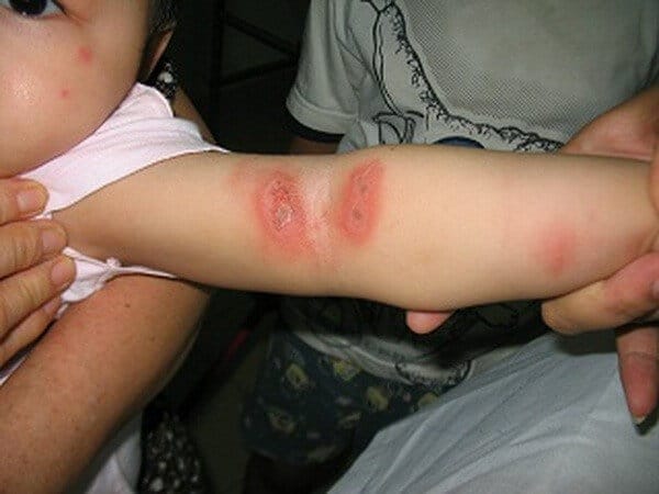 Cách chữa trị khi trẻ bị côn trùng cắn sưng mủ