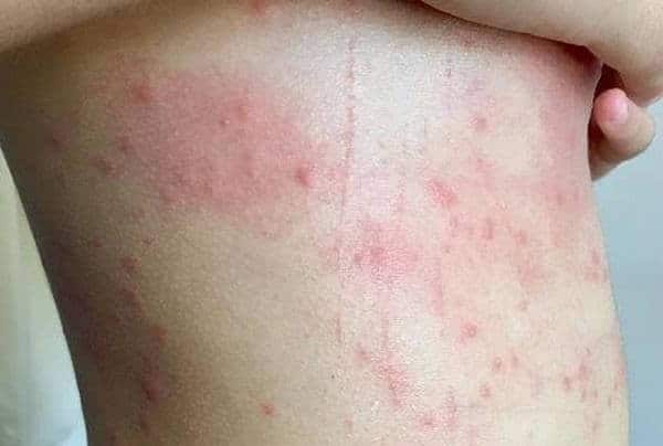 Hiện tượng da bị nổi nốt đỏ như muỗi đốt ngứa thường thấy