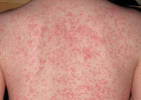 Bị muỗi vằn đốt có bị sốt xuất huyết không?