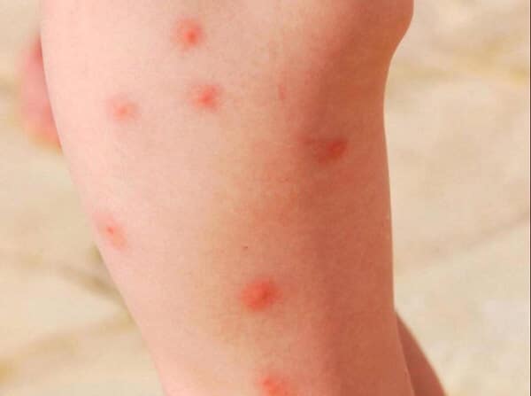 Muỗi đốt gây nhiễm trùng da, để lại sẹo