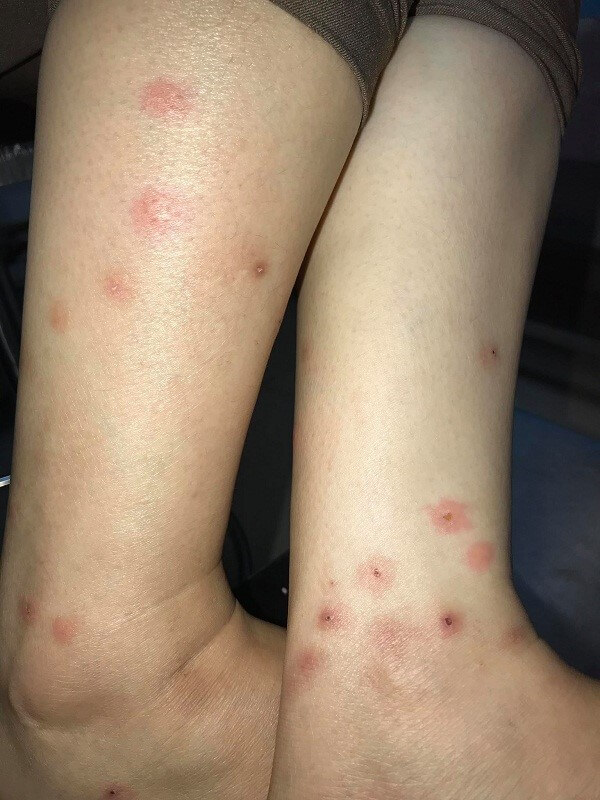 Chân tay bị sưng khi bị muỗi cắn